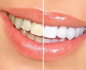 Teeth Whitening