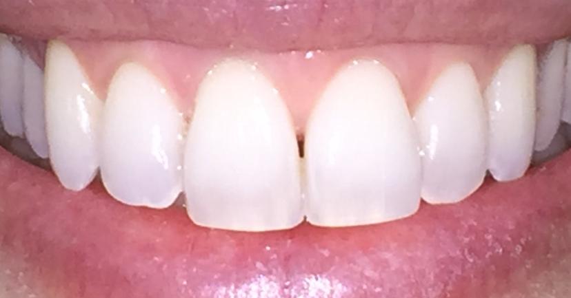 After Composite Bonding - case 1