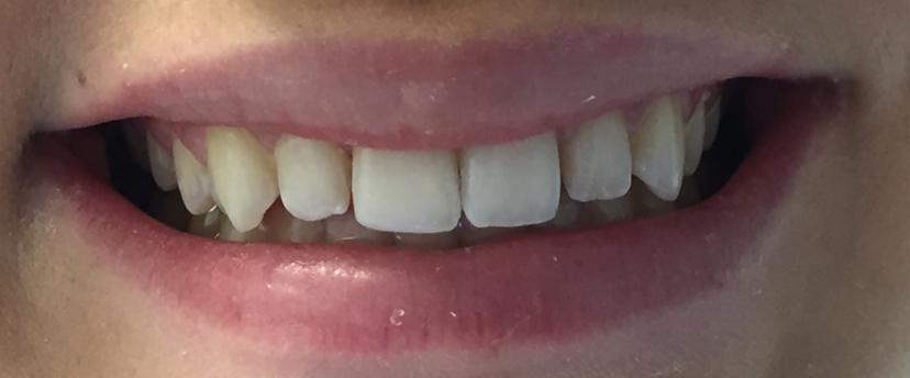 After Composite Bonding - case 2