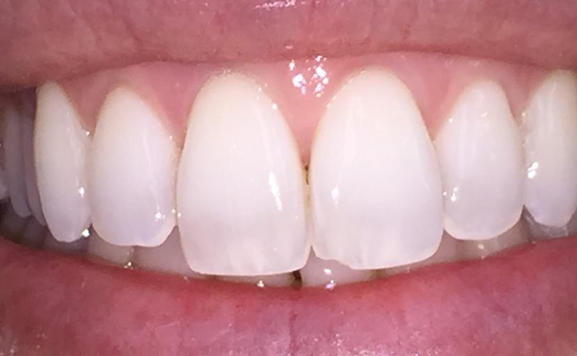 Before Composite Bonding - case 1