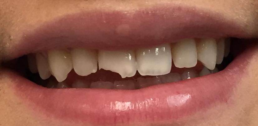 Before Composite Bonding - case 2
