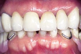 After Dental Bridges - case 1