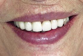 After Dental Bridges - case 2