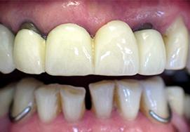 Before Dental Bridges - case 1