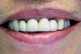 Before Dental Bridges - case 2