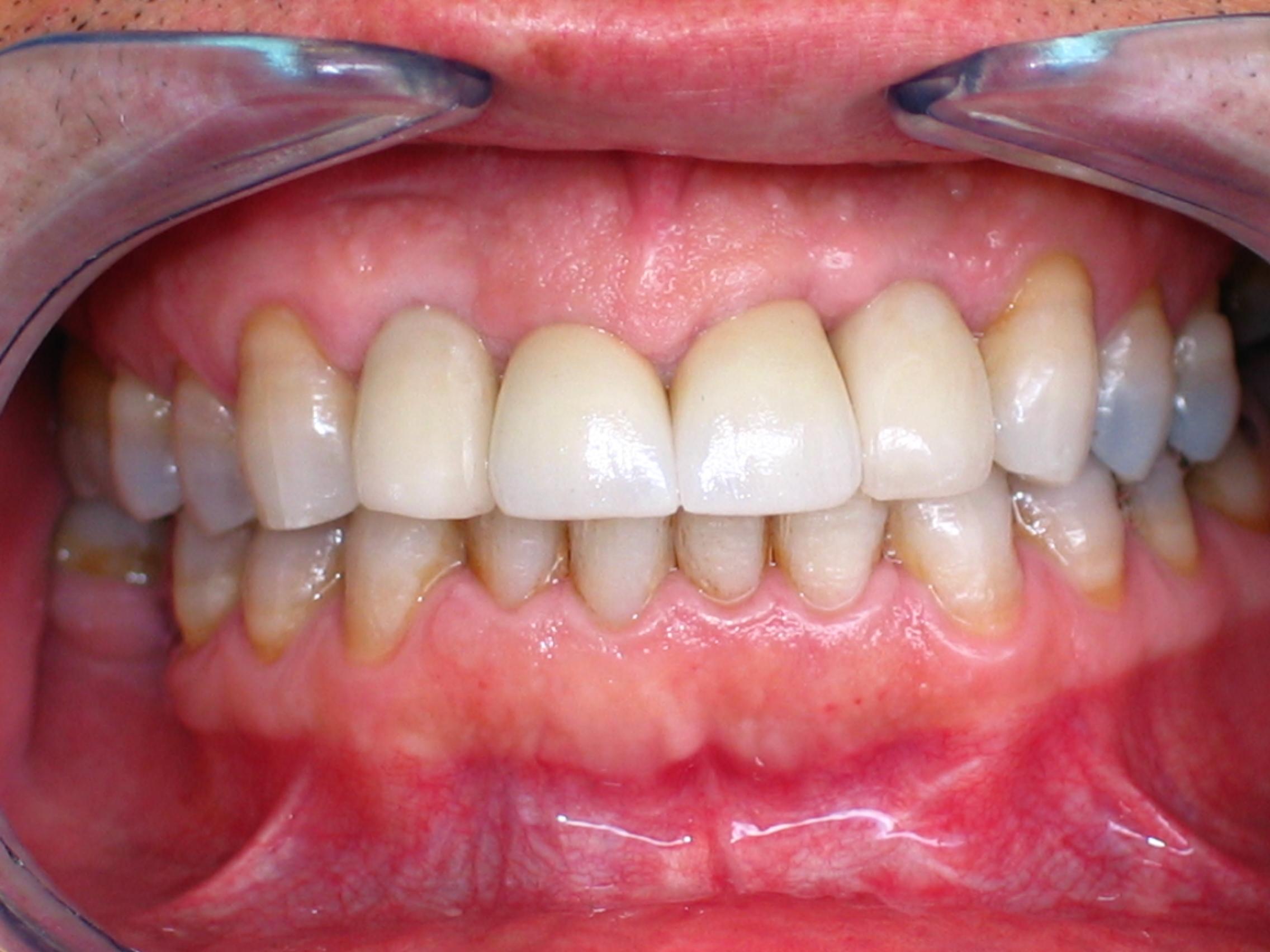 Patient 1 after dental implants