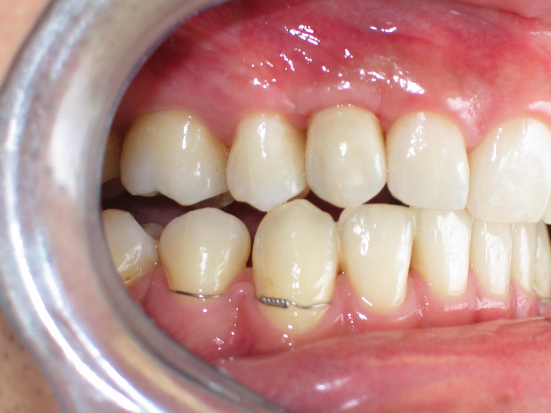 Patient 2 after dental implants