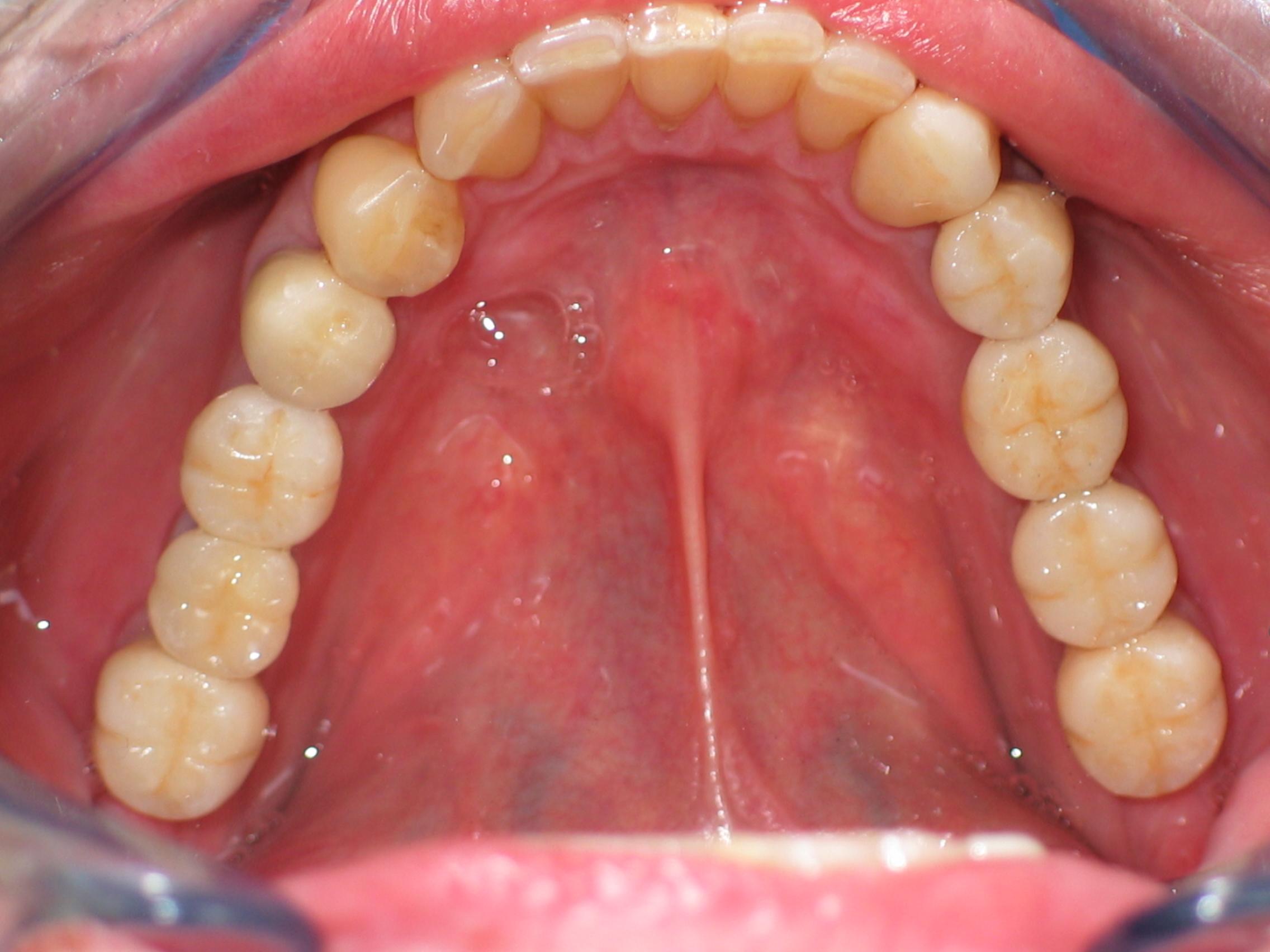 Patient 3 after dental implants