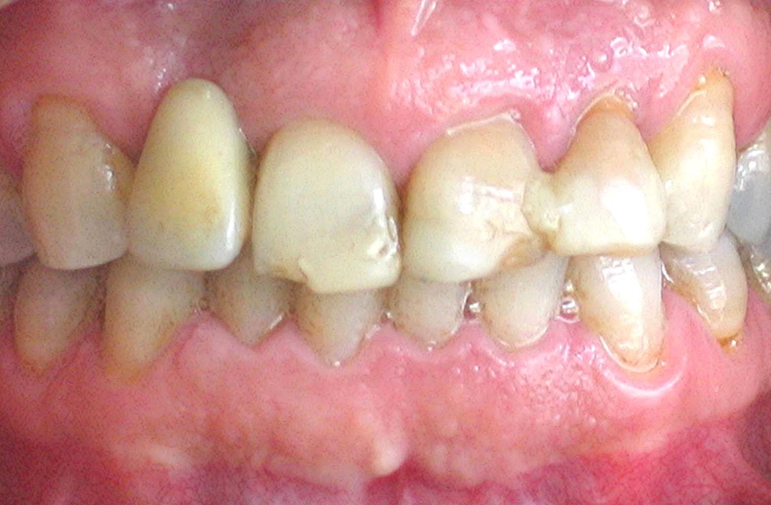 Patient 1 before dental implants