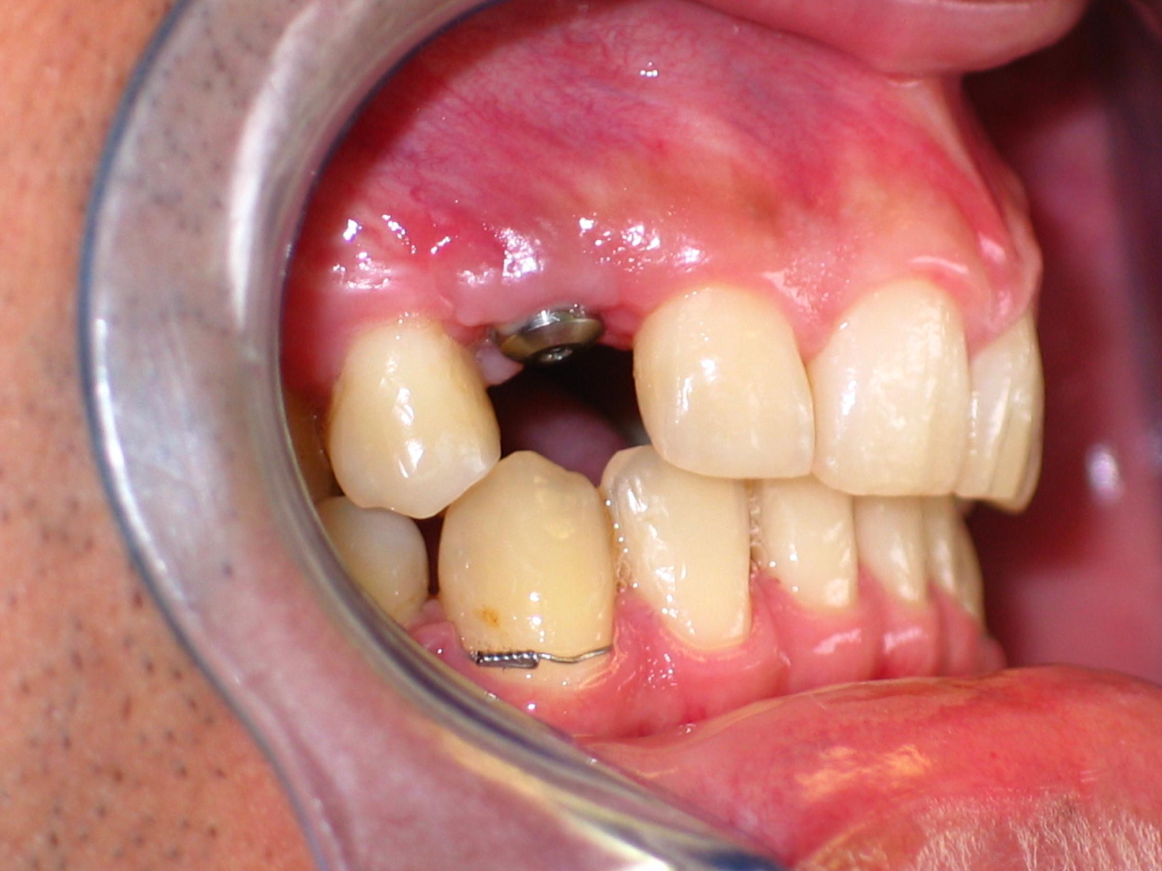 Patient 2 before dental implants