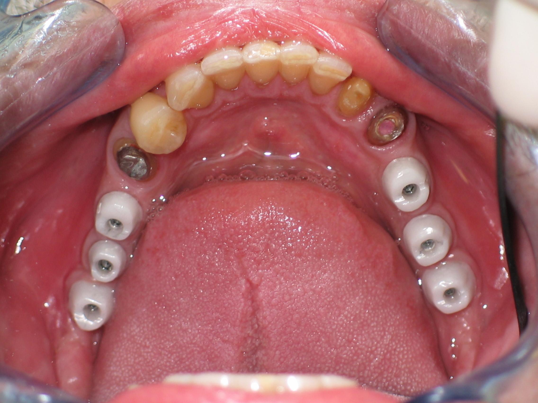 Patient 3 before dental implants