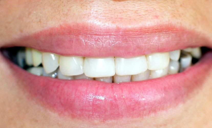 After Revitalize Your Smile - case 1