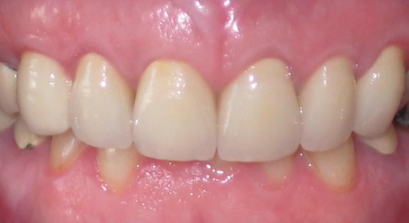 After Revitalize Your Smile - case 2