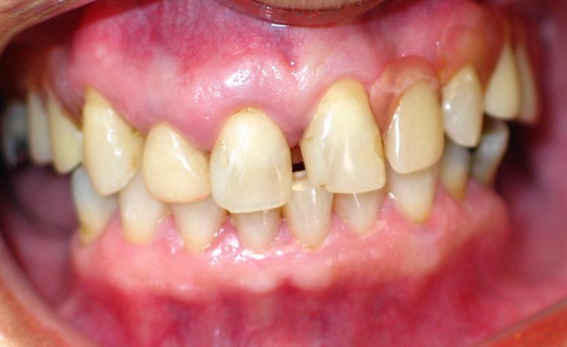 Before Revitalize Your Smile - case 1