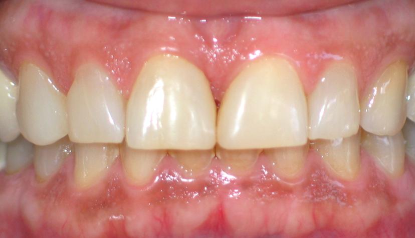 After Porcelain Veneers - case 1