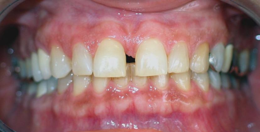 Before Porcelain Veneers - case 1